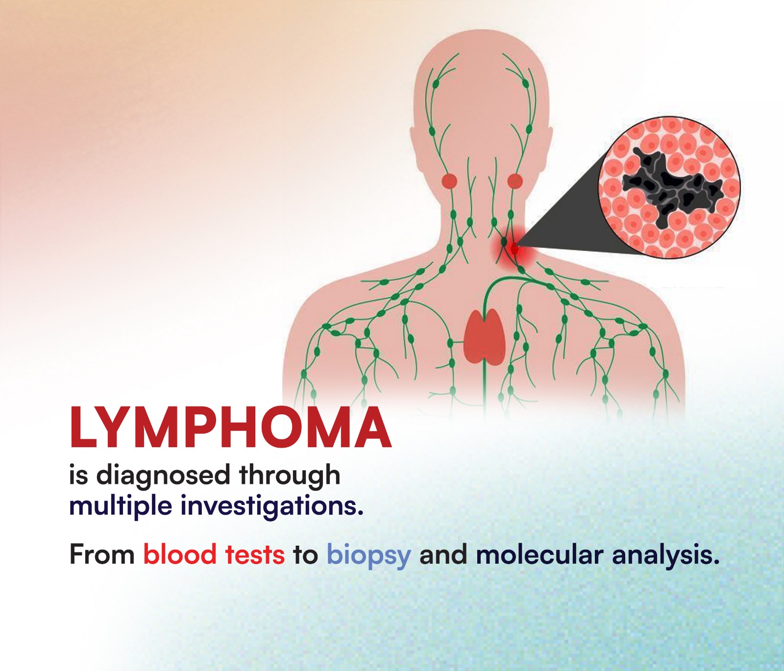 Lymphoma Symptoms and Diagnosis: NPL’s Diagnostic Guide
